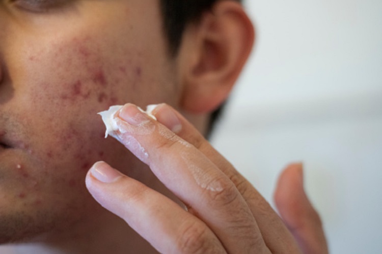 a person applying cream on acne spots
